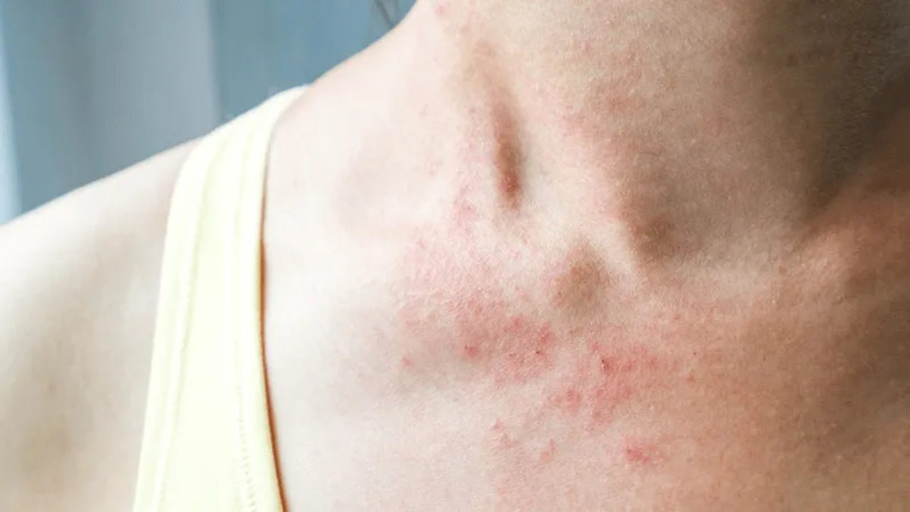 Eczema and Dermatitis on Extended Passages